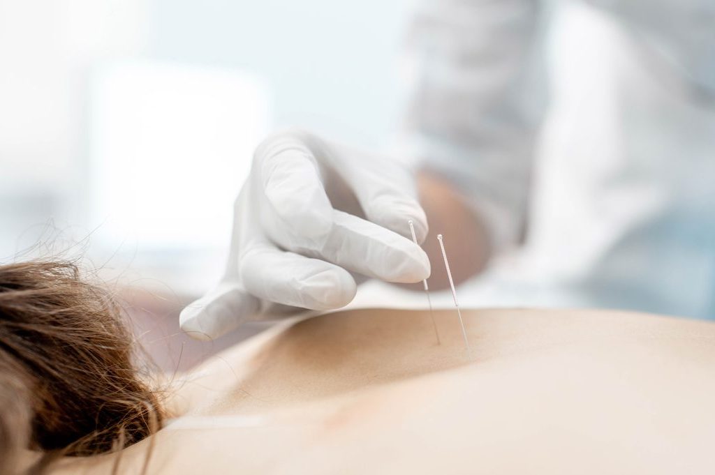 TCM_T_Acupuncture